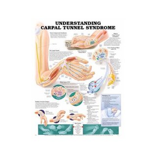 Carpaal tunnelsyndroom poster Engels