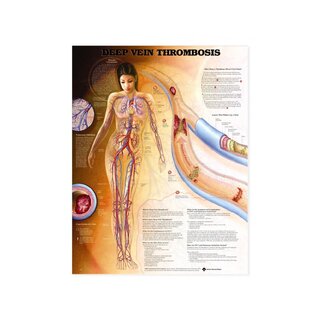 Diepe veneuze trombose (DVT) - poster