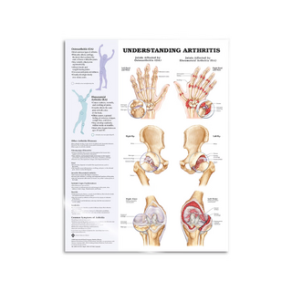 Artritis gelamineerd Engels