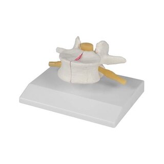 Osteoporosewervel, 2 keer de natuurlijke grootte