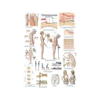 Poster over osteoporose, anatomische poster 50x70 cm