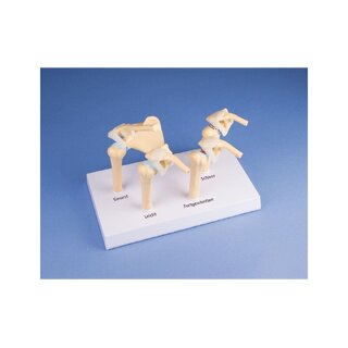 Model 4-stadium artrose (OA) schouder
