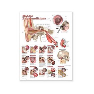 Ziekten van het middenoor gelamineerde poster Engels